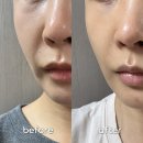 핸드피스닥터 | 올타이트리프팅 600샷 받고 바로 얼굴 라인 하프해진 클리닉 후기