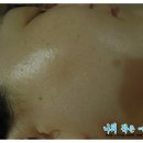 토픽피부관리실 | [다대포피부관리실]토픽피부관리실에서 아쿠아필링과 PDT 받았어요!!