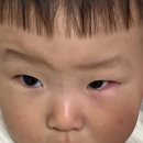 셀메드드림약국 | 돌전아기 눈밑 빨개짐 , 다래끼 전조증상 ?