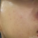 오안과의원 | [시지피부관리/경산피부관리] 메리케어스킨앤바디 연예인 물광필링 후기