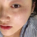 영주진단방사선과의원 | 압구정 루비의원에서 기미, 주근깨 털고 온 후기