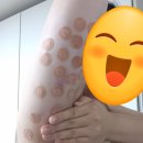 브라운성형외과의원 | '신논현역 브라운성형외과' 지분주사 후기｜팔뚝 지방분해주사 대용량 200cc 체험