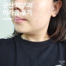 군산피부과에서 리쥬베룩 말고 결절없는 진짜콜라겐주사 미라콜 받아본 내돈내산 후기