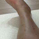 메디럭스 | 임신 초기에 있었던 이슈 모음 zip | 2형 당뇨 임전당산모의 혈당 잡기 | 난임병원 졸업과 한마음병원...