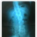[디스크｜허리디스크] - 척추변위증의 자생 치료법 이미지
