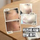리즈약국 | 리즈네 시술 한 달 후기 (당일·1일·2일·1주·2주) 경과 정리 (통증·엠보·효과)