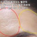 6년간 지속중. 고문 받는 피부가 유난히 울퉁불퉁해짐. 이미지