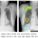 폐 섬유화 어떤 것들이 있을까 이미지