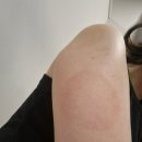 타임피부과의원 | 📌 [시청역피부과 써밋의원 후기] 봄 맞이 팔뚝정리! 바디온다 10만줄 시술 후기💪🌸