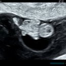 유산1 | 1년동안 2번 유산 후, 재 임신 후기 (37세 노산산모)