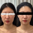 쉼드림 | W14. 대전 신부관리 마음쉼에스테틱 내돈내산 찐추천 후기(얼굴 리프팅 5회, 상체 슬리밍 5회)-2