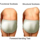 측만증[scoliosis] 이미지