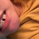 [제천 종로미시간치과] 제천 치과 임플란트 내돈 후기 (2023년 12월 ~ 24년 5월) 치과 보험 임플란트...