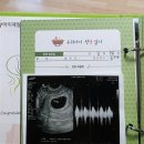 은평구보건소 | 임신 6주 아기 심장소리 확인 은평구 보건소 초기 산전 검사 무료 후기