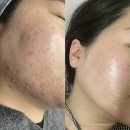 리온메디칼 | 성신여대 피부샵 여드름관리 여드름압출 맛집_리온에스테틱 (내돈내산)