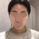 바른뜸한의원 | (만족😃)텐써마 300샷 후기 내돈내산 #1 | 오라클피부과 경기광주점 후기 | 전후비교샷