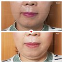 한미르지남한의원 | [강릉 한의원]턱관절 통증 차별화된 프로그램으로 치료 자필 후기
