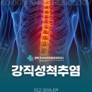 코끼리마취통증의학과의원 | 등이 굽는 느낌과 가슴 통증, 강직성 척추염