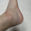 마디온정형외과 외 | 발목 인대 파열수술 (전거비, 종비인대) ㅣ입원후기ㅣ 보험청구