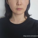 멍마실 | 압구정역피부과 울쎄라 300샷 리프팅 시술 통증 멍 효과 후기