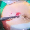 나노치과의원 | 아이 흉터, 아이 이마 찢어짐 걱정 없이! 동탄 성형외과 미세봉합수술 후기