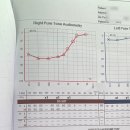 멍멍대학 | 돌발성난청 대학병원 치료 완치 스테로이드 부작용 어지럼증 후기