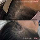 청담그레이스 김포/리턴세럼 반영구 제거/타투제거 전문