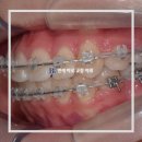 연세바로치과교정과치과의원 | 연세바로치과교정과치과의원 목동점 클리피씨교정특징 잦은 내원과 통증 부담 줄여보세요