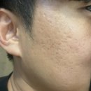 오름한의원 | 오름테라피 후기 :: 광주 한의원 여드름 흉터 치료 2주차 사진 多