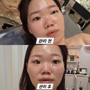 위드미 구미인동점 | 구미피부관리 잘하는 곳 선샤인미뷰티케어, 진짜 피부 열감이 사라졌어요!