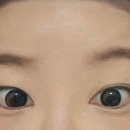 삼산약국 | 울산 삼산피부과 이마필러 5cc + 미간, 이마 보톡스 전후, 리터치 후기