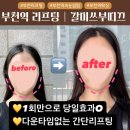 크라운호프 부천약대점 | 【갈미스부띠끄】 부천역 리프팅, 하이푸리프팅 후기 (동영상有)