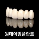 더서울디지털치과의원 | 원데이임플란트 후기 좋은 곳 왜 서울하늘에치과인가