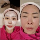 코레이지(Corage)레이저 생생후기 체미안 부천점