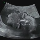 임신24주차 미래여성병원 정밀 초음파 &amp; 임당 검사 후기