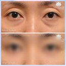 대구눈밑지방재배치 가격만 보고 선택하면 안되는 이유 이미지