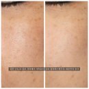 김포한강2로23번길-R | 검단 신도시 김포 기미제거 미작뷰티 김포 클리어스팟으로 피부관리 후기