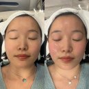 잠실의료기기 | [엔진리프팅]잠실 피부과에서 통증 없이 리프팅, 팔자고민 이별