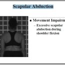 Scapular Abduction. 견갑골 외전 변형의 치료 이미지