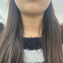 민가한의원 | 강남 페이스 코르셋 이중턱 (매선 실리프팅) 레알 찐 후기