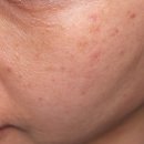 송화초등학교 | 화곡동피부과 리투오 스킨부스터 손주사 통증 솔직 후기 (50대 피부관리)