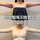 1150 | 부산 팔뚝 지방흡입 리얼후기｜수술 당일, 1,150cc 뽑은 비용·통증·붓기 총정리