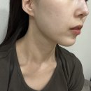 투명피부과의원 | 논현역 피부과 시네마의원 레이저 프리미엄 후기