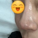 대전 반영구 제거 파란 회색끼도는 문신 지우기 쥬니엘뷰티 내돈내산 후기