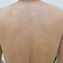 새로한의원 | 팔모공각화증 해결하고 새로 태어난 한의원 관리 후기