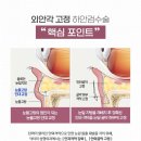 하안검수술 후기, 닥터미성형외과