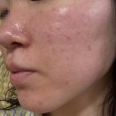 서울위드성형외과의원 | [피부과] 픽셀랩성형외과의원 | 포텐자 N팁 700샷 + 쥬베룩 2cc 2회차 내돈내산 리얼후기