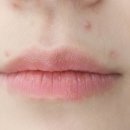 포록 | 입주변 여드름 원인, 반복되는 턱 주위 트러블 뾰루지 피부염 관리 방법