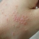 다래뜰 | 대상포진 후기, 전조 증상부터 진행 과정과 회복 기간까지 총정리