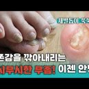 자존감을 깎아내리는 무시무시한 무좀! 이젠 안녕~ 이미지